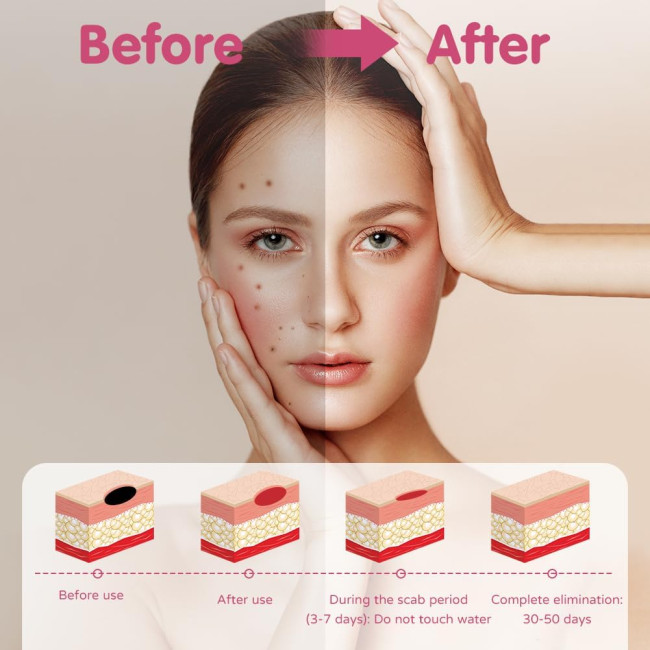 Комплект для видалення родимок AOGOE 1103, з 9 режимами та РК-дисплеєм (0149)